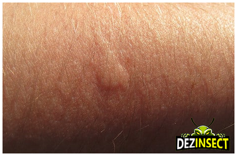 afectiuni provocate de intepaturile tantarilor